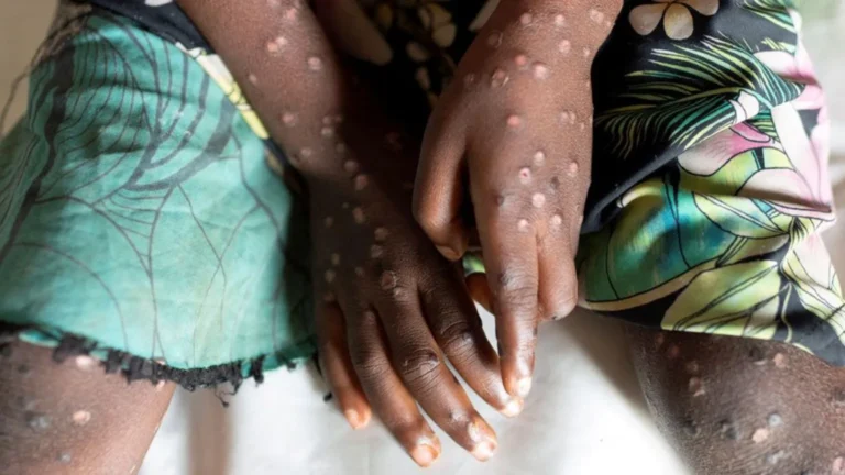 WHO declares mpox a global public health emergency amid vaccine delays